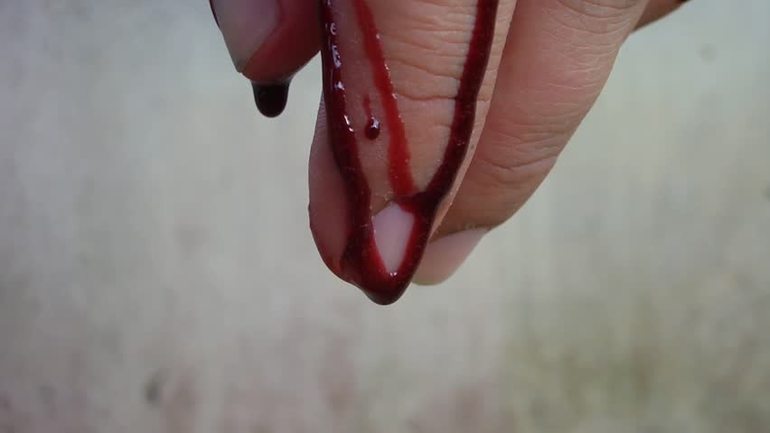 До чого сниться кров на руках: тлумачення порізу на пальці за різними сонникам