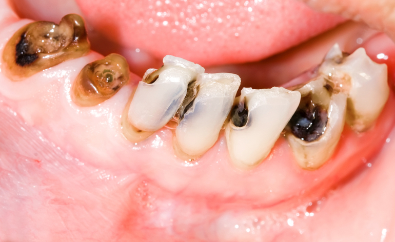 До чого сняться гнилі зуби в роті: зіпсовані, чорні, тлумачення для чоловіків і жінок