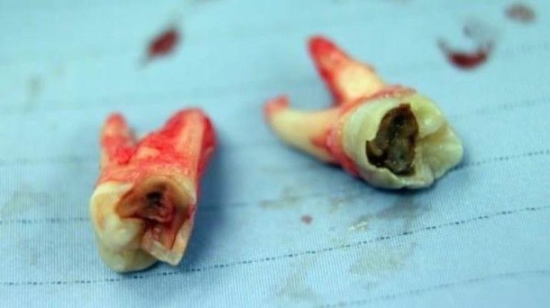 До чого сняться гнилі зуби в роті: зіпсовані, чорні, тлумачення для чоловіків і жінок