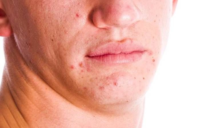 До чого сняться прищі на обличчі: місце, де вискочив вугор, великий або маленький