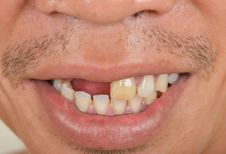 До чого сняться вибиті зуби: значення зубів з кров’ю чи без у популярних сонники