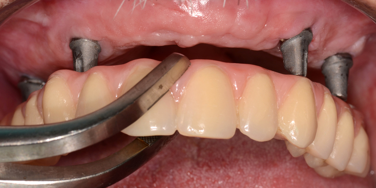 До чого сняться зубні протези: бачити зламану вставну щелепу, тлумачення по сонникам