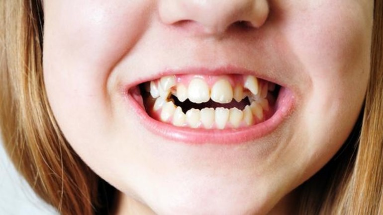 Криві зуби в сні: докладне тлумачення сонників і попередження сновидінню