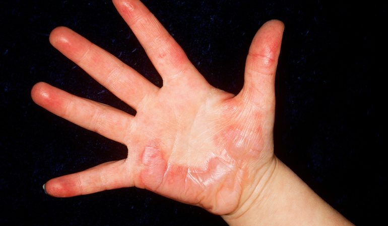 Опік по соннику: трактування сновидіння в популярних толкователях