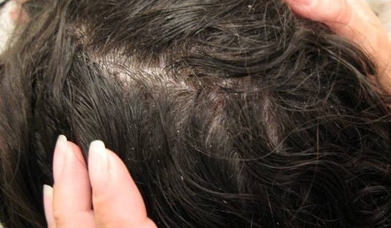 Тиснути вошей у сні: значення бачення по сонникам, що означає вбивати паразитів на дитячій голові