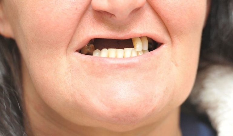 Вирвати зуб за сонником: до чого може приснитися видалення без крові, думки різних тлумачів