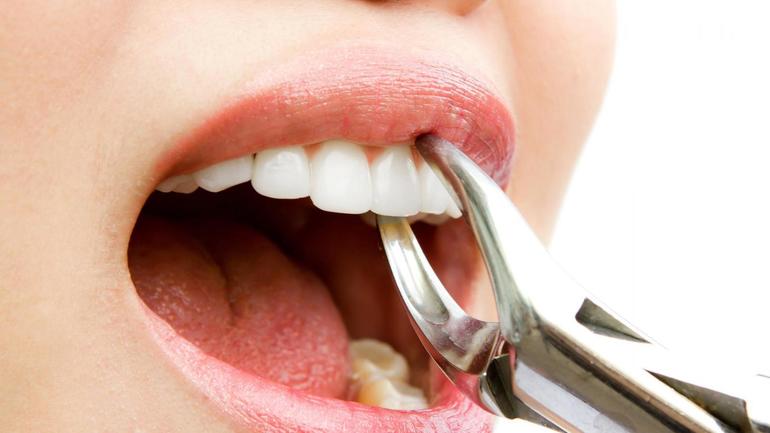 Вирвати зуб за сонником: до чого може приснитися видалення без крові, думки різних тлумачів